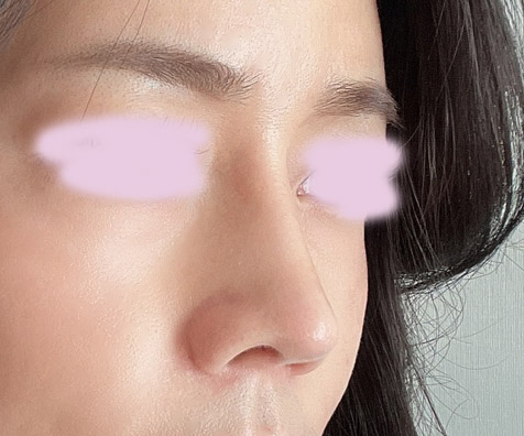 매부리코성형 세달차!