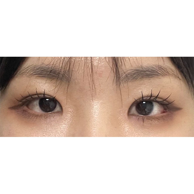 눈수술3갤차~~붓기 증말 빨리빠짐요