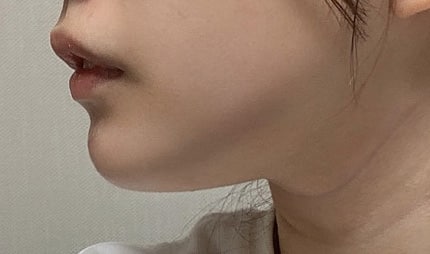 옆에서 봤을때 이중턱이 없어졌어요~!