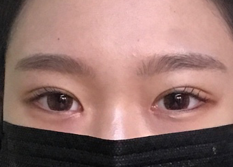 수술 전,후 사진 보고 깜짝 놀랬어요ㅋㅋㅋ