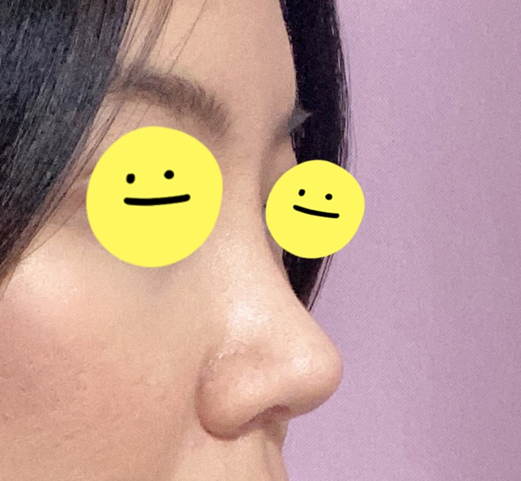 바이브에서 눈+코수술 1달지났어용~