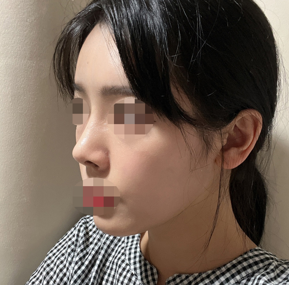 코+지방이식 대만족bb