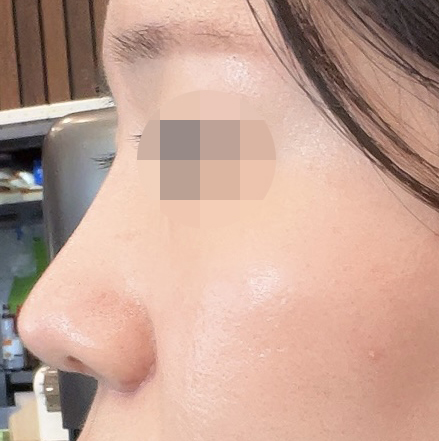 복코재수술 추천추천!