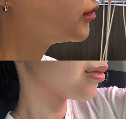 턱살이 확 줄어든게 보여용!!