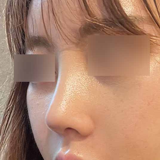 기증늑 코수술 3주차