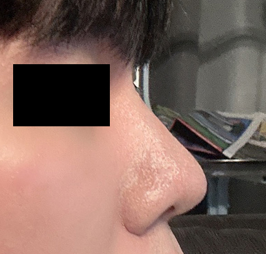 유영문원장님께 코수술 받고 4개월차 접어듭니다.