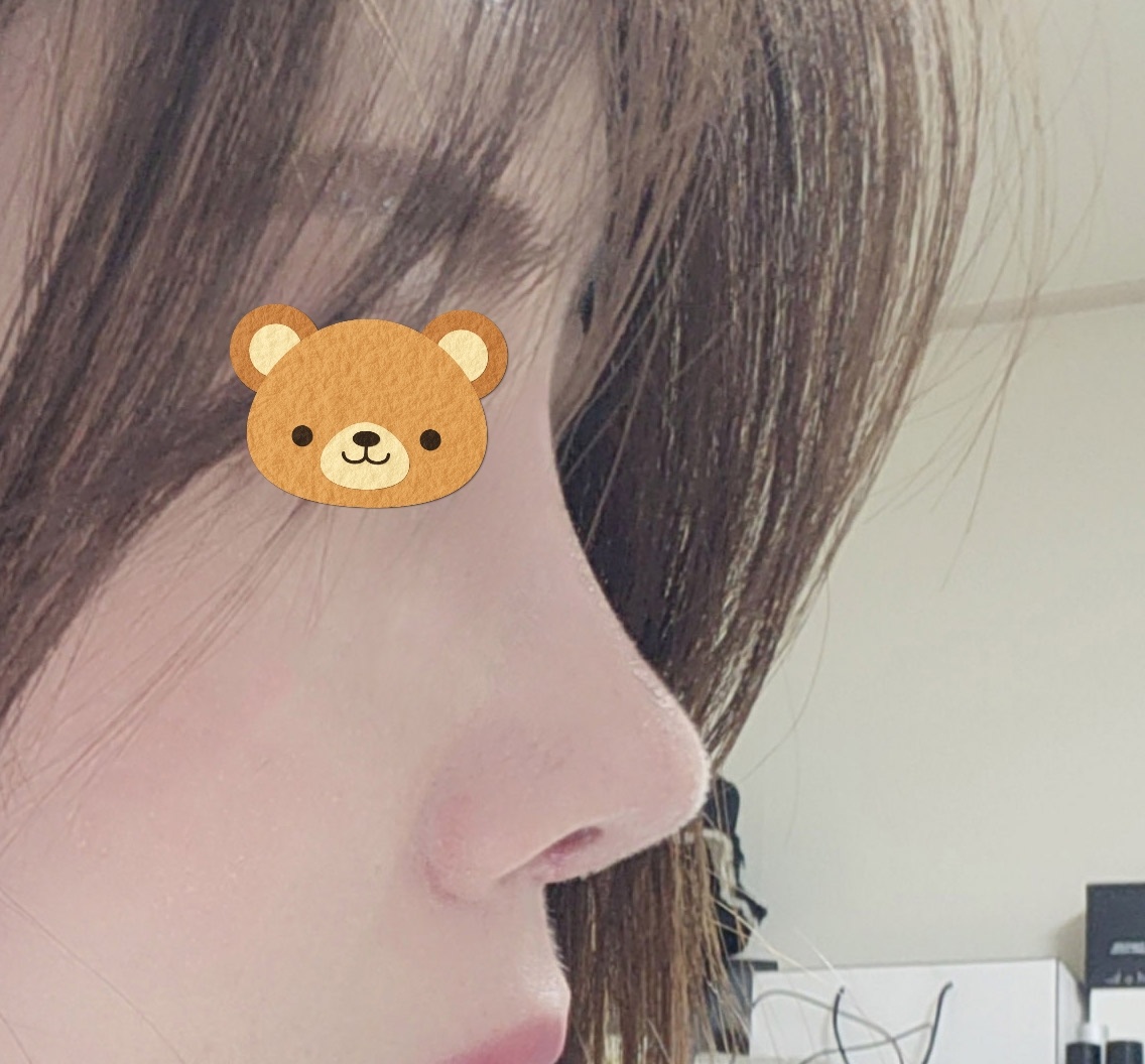 기능코성형 1달차입니당