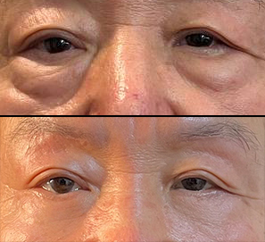 아버지 중년눈성형후기에요~