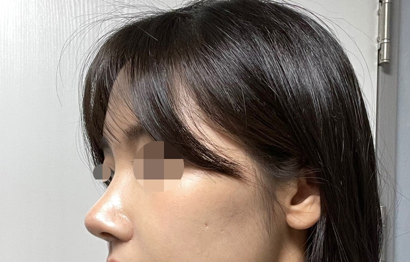 코성형 만족 200%