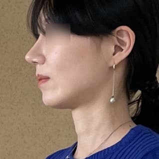 코재수술 4개월차 만족입니다!