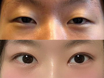 눈매교정하구 졸린눈탈출!