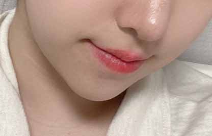 수술당일날부터 이중턱흡입 효과 봤어요ㅎㅎ