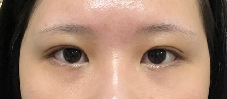 부분절개눈매교정 3개월차