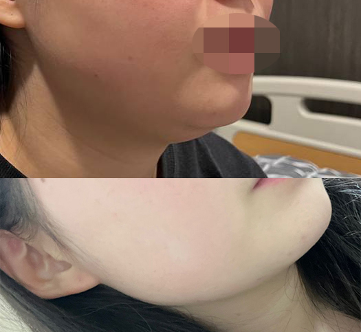 숨겨져있던 턱라인 얼지흡하고 찾았습니다ㅎㅎ