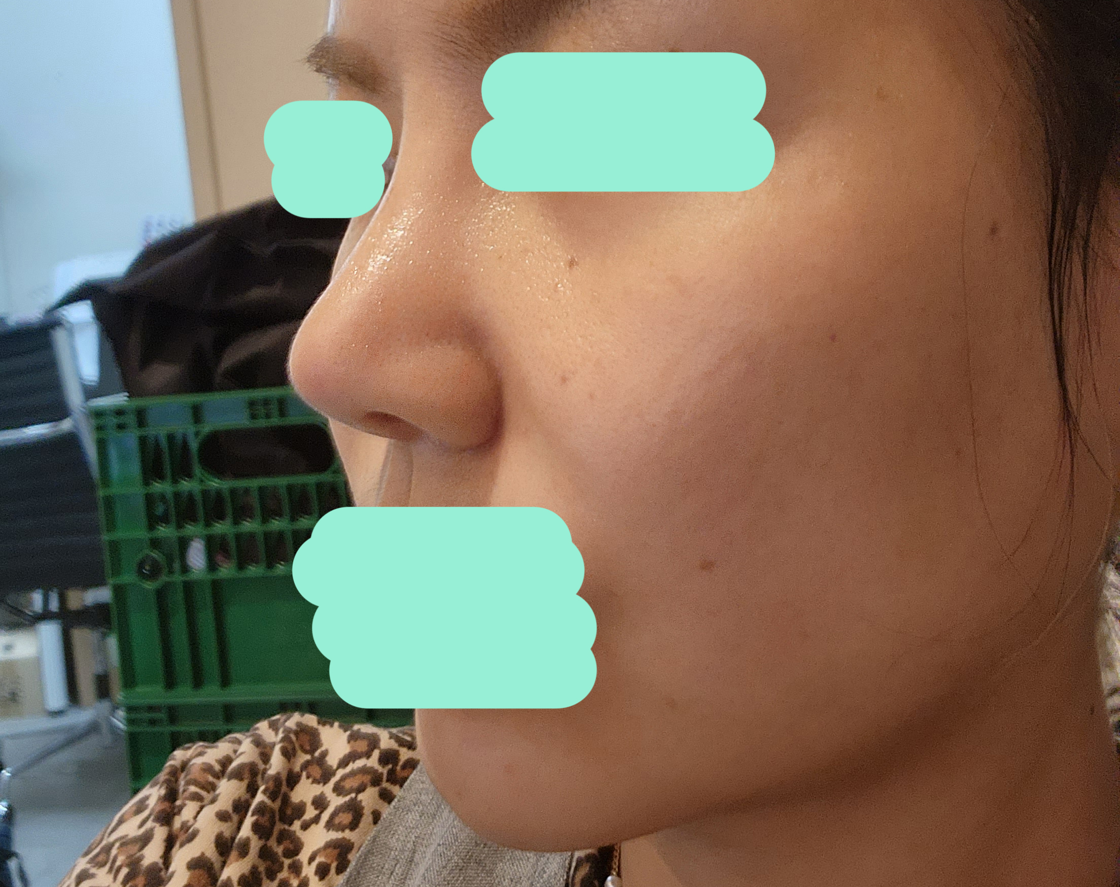 10년전 코하고 바이브에서 재수술했어요