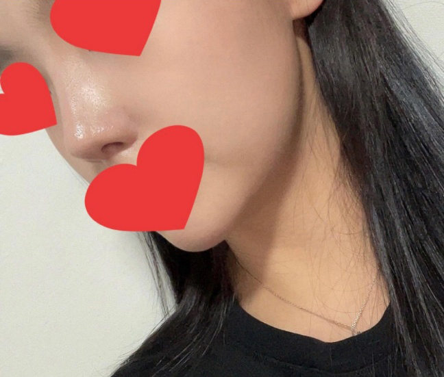 벌써 7개월차됐어요ㅎㅎ(코, 얼굴지방흡입후기)