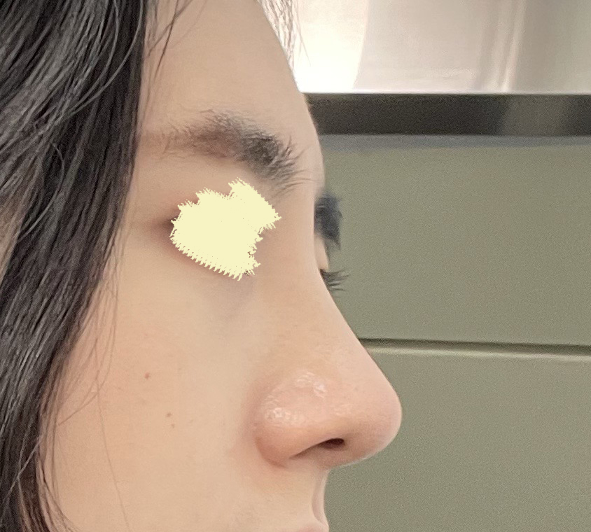 매부리코, 무보형물로 해결했어용