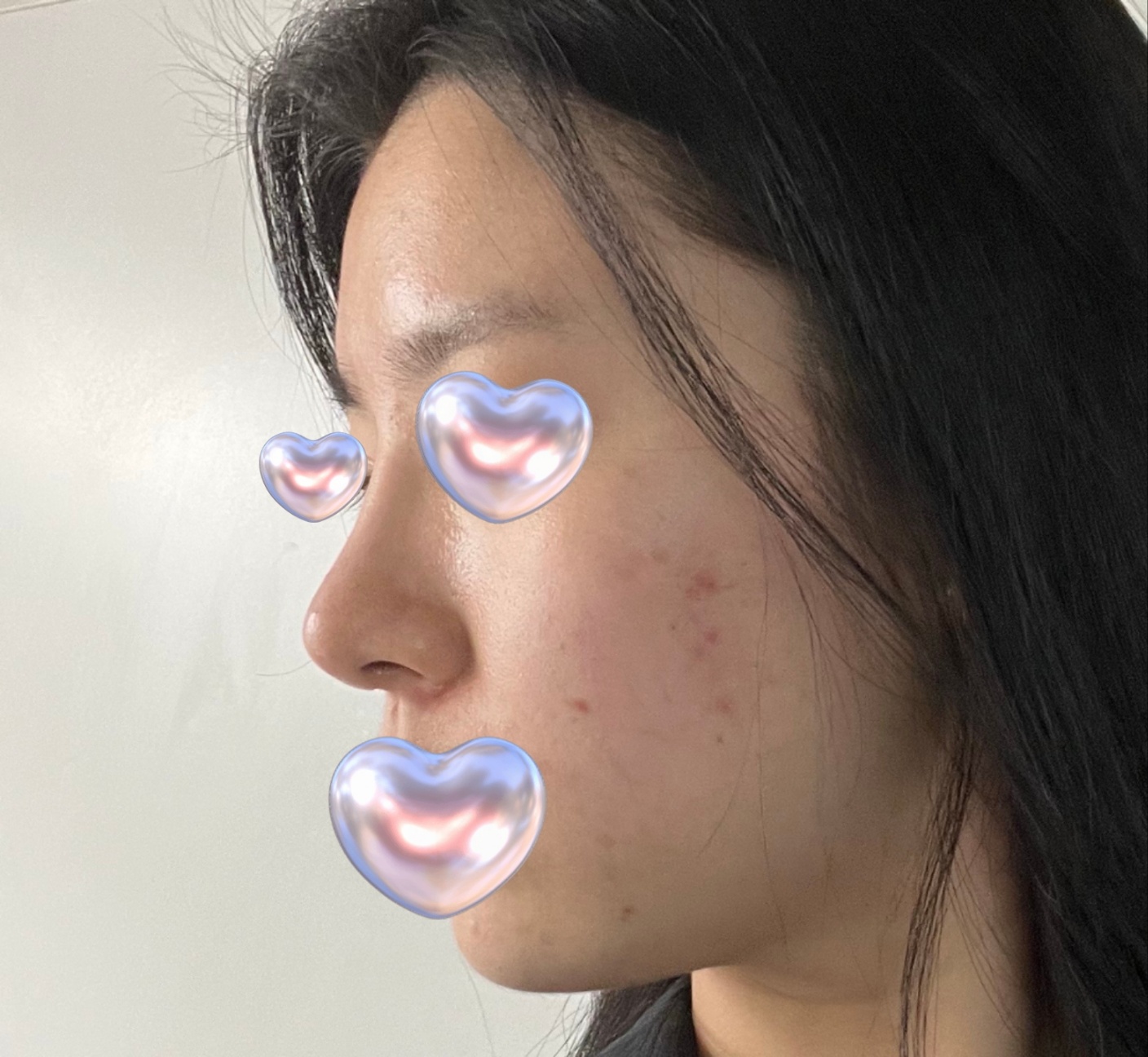 코성형5개월차, 분위기가 달라졌어요:)