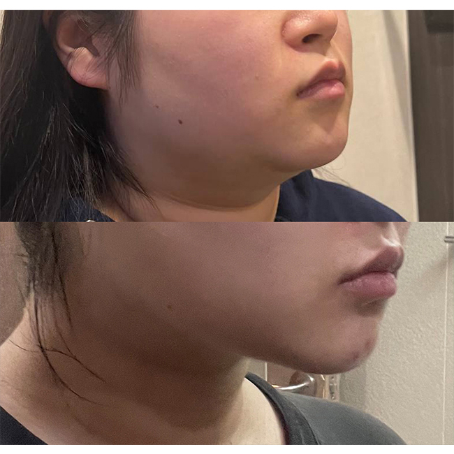 수술전후45도측면.jpg