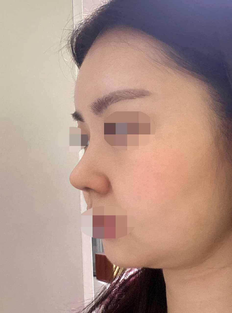 눈밑지방재배치, 코끝 무보형물 ㅎㅎ