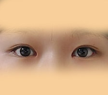 첫눈성형 2개월됐어용~