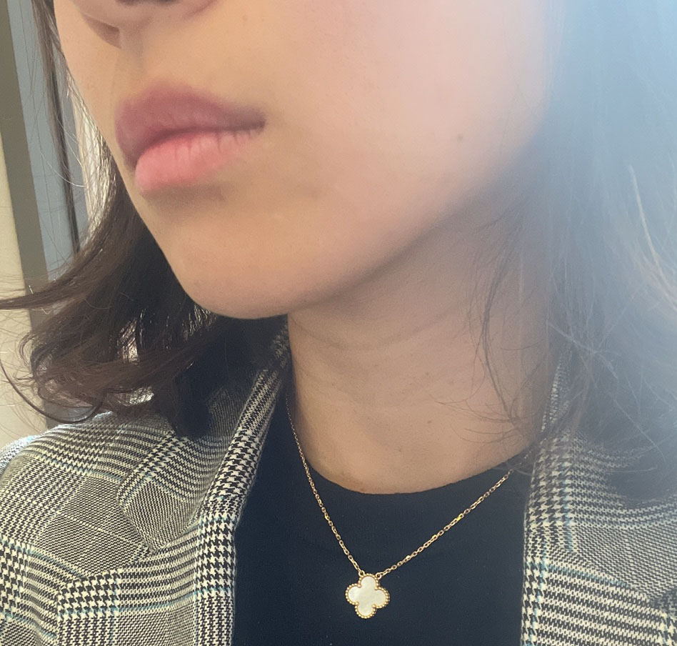 얼굴지방흡입 전후차이 장난아니네요~