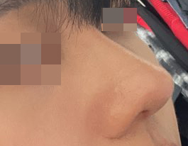 남자매부리코+복코+긴코 교정 1달차