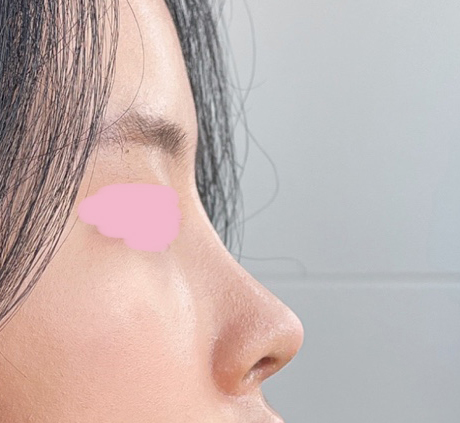 다들 잘됐다그래요 ㅎㅎ 코 1개월차~