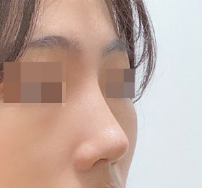 눈재수술+코 6개월 만족후기ㅎㅎ