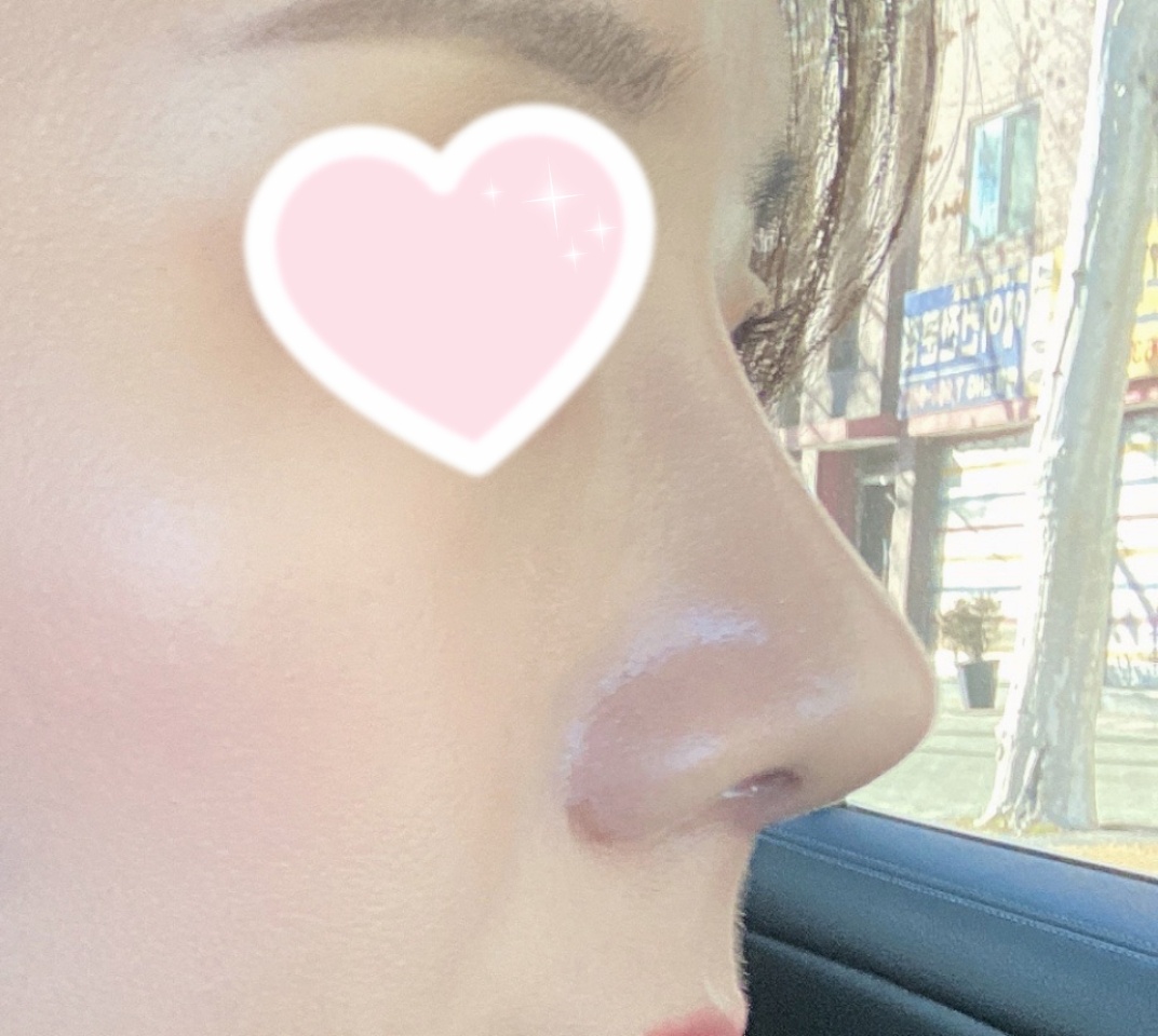 눈코성형 바이브추천해요!