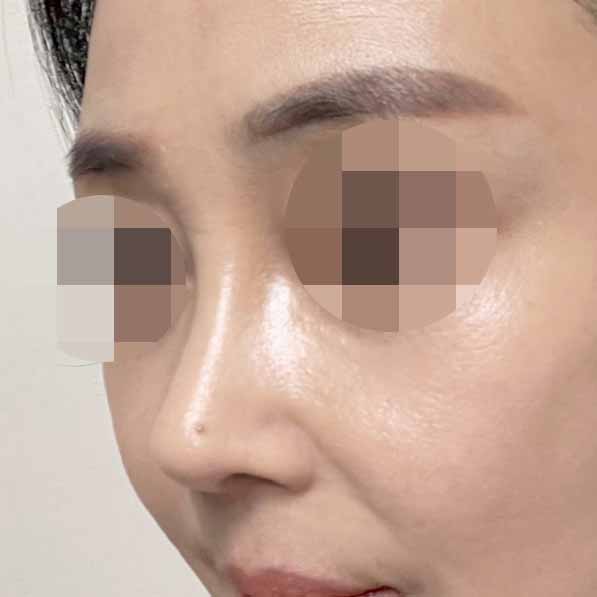 코수술후 거울 보면 예뻐 보여서 만족중!