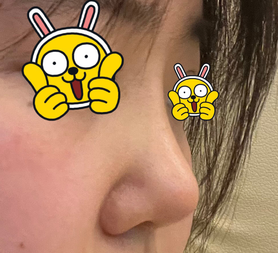 복코성형 자연스럽게 잘 된거같아요:)