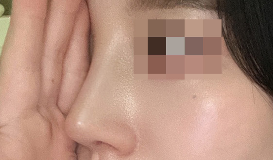 눈코재수술 성공후기에용