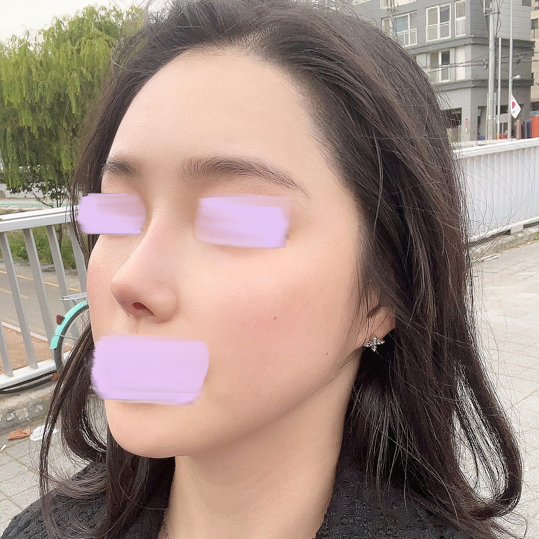 코3번째수술, 그리고 풀페지이했어용+3달차