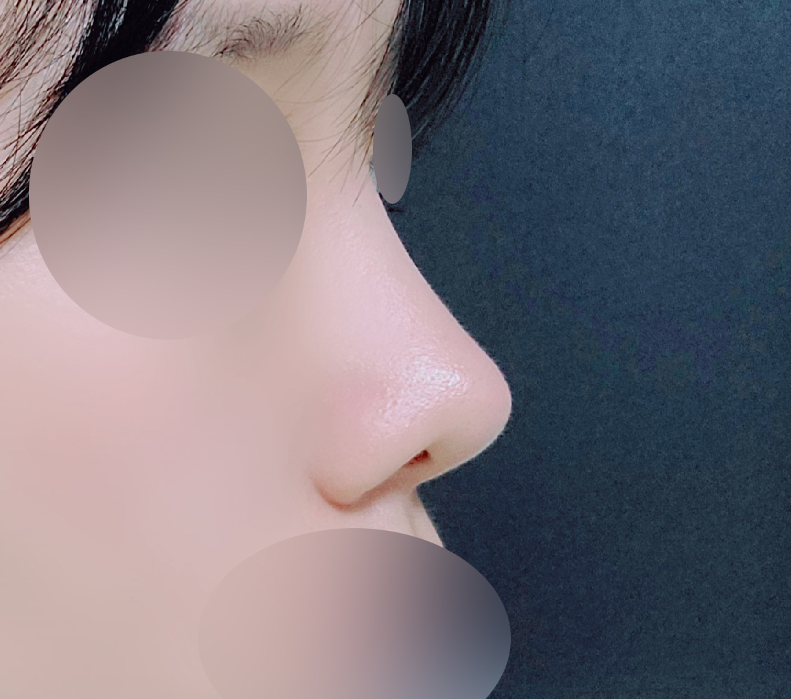 긴코재수술후기입니다~~!