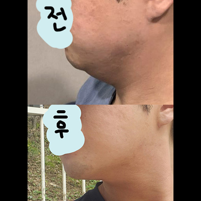 비절개 얼굴지방흡입 만족후기씁니다