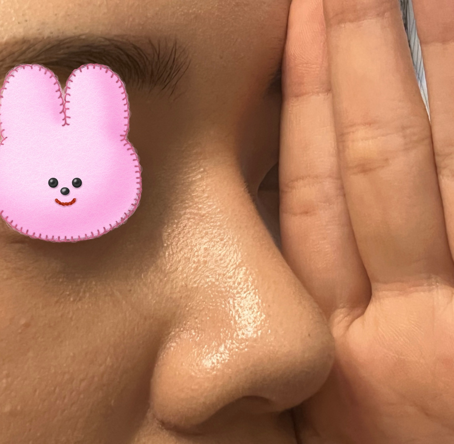 코수술 6개월지난 후기! 만족중~~~