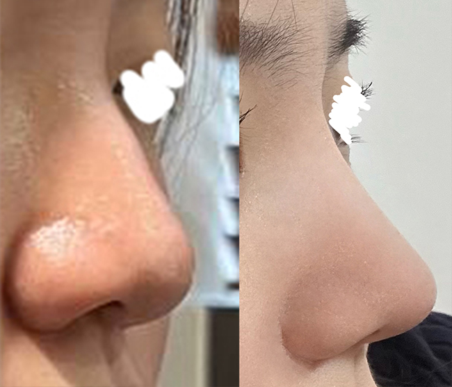 바이브에서 코성형했어요!