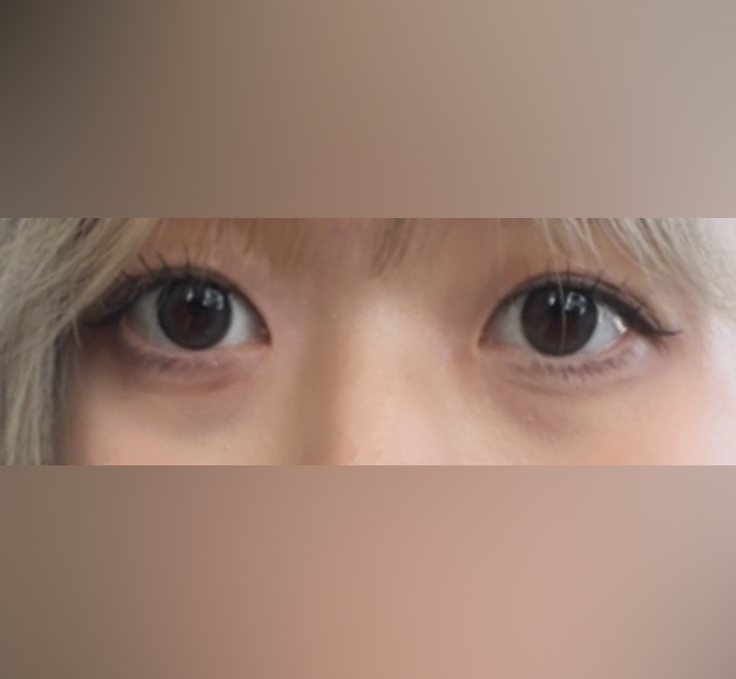 부분절개눈매교정하구 새 삶 살고 있어요 ㅎㅎ