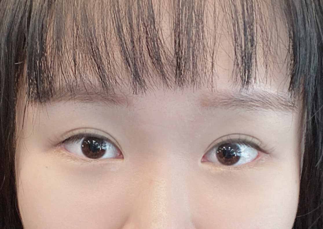 트임이랑 얼굴지흡 너무 만족스러워요:)