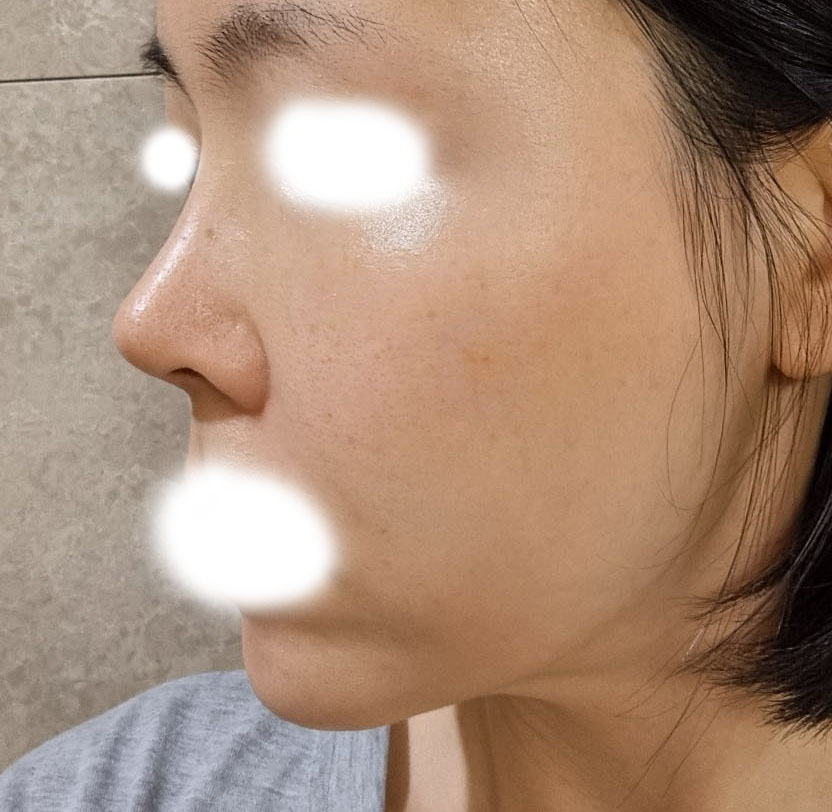 수술 한달차 경과했습니다^^