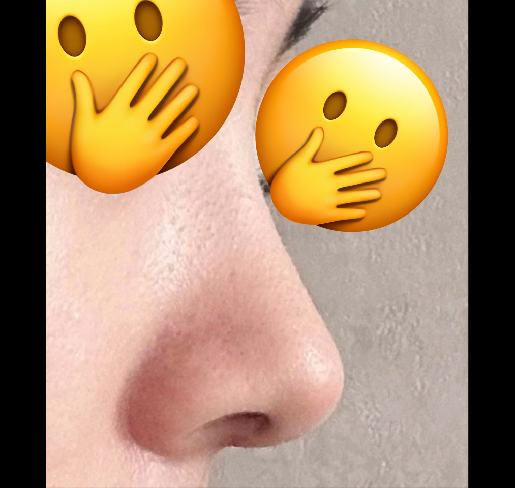 유영문원장님께 코수술받았어요