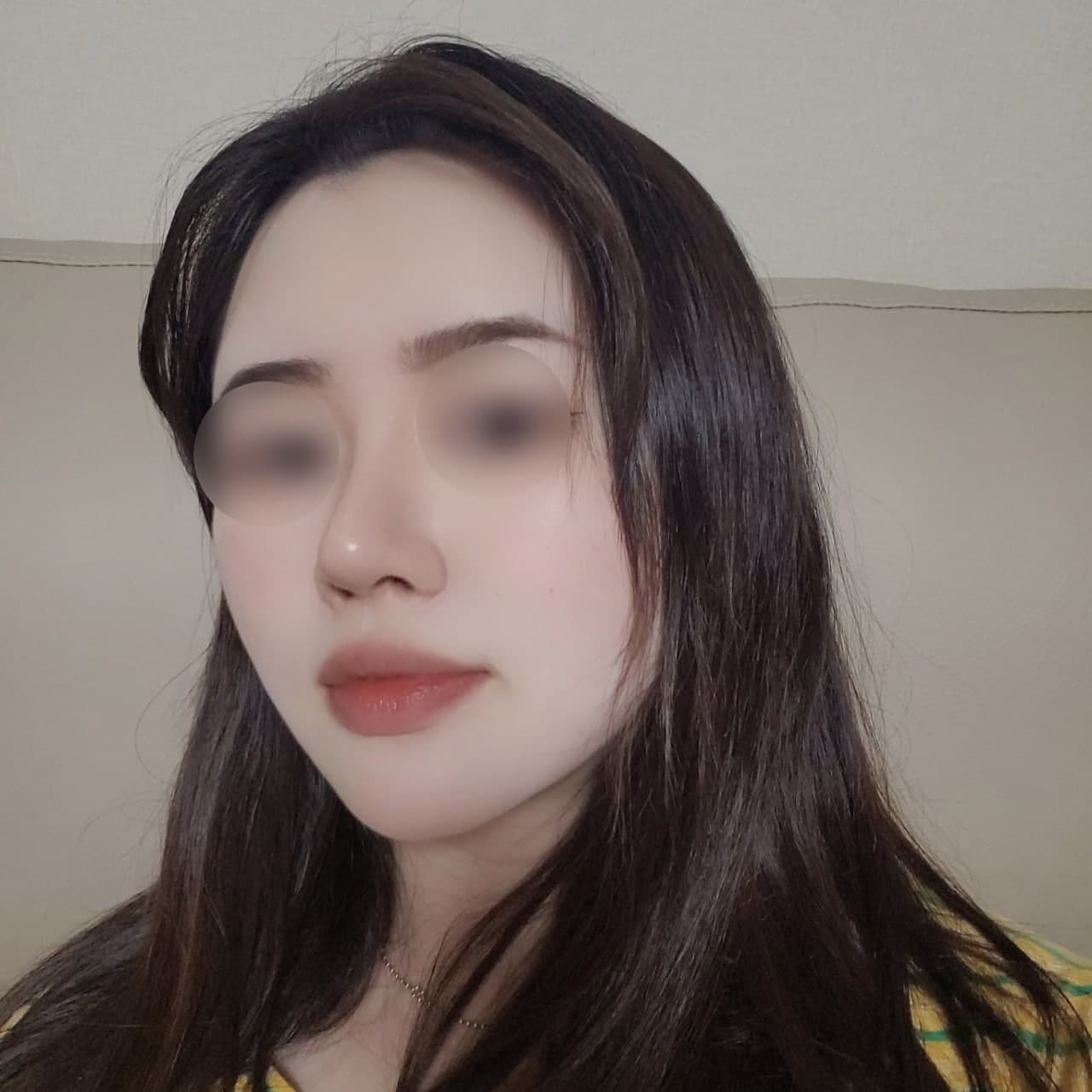 바이브에서 코 수술 + 이중턱 지흡 + 이마 지방이식 + 심부볼 제거  3달차 후기입니다