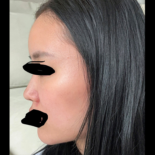 얼지흡, 얼굴지이 잘된 후기 보셔요:)