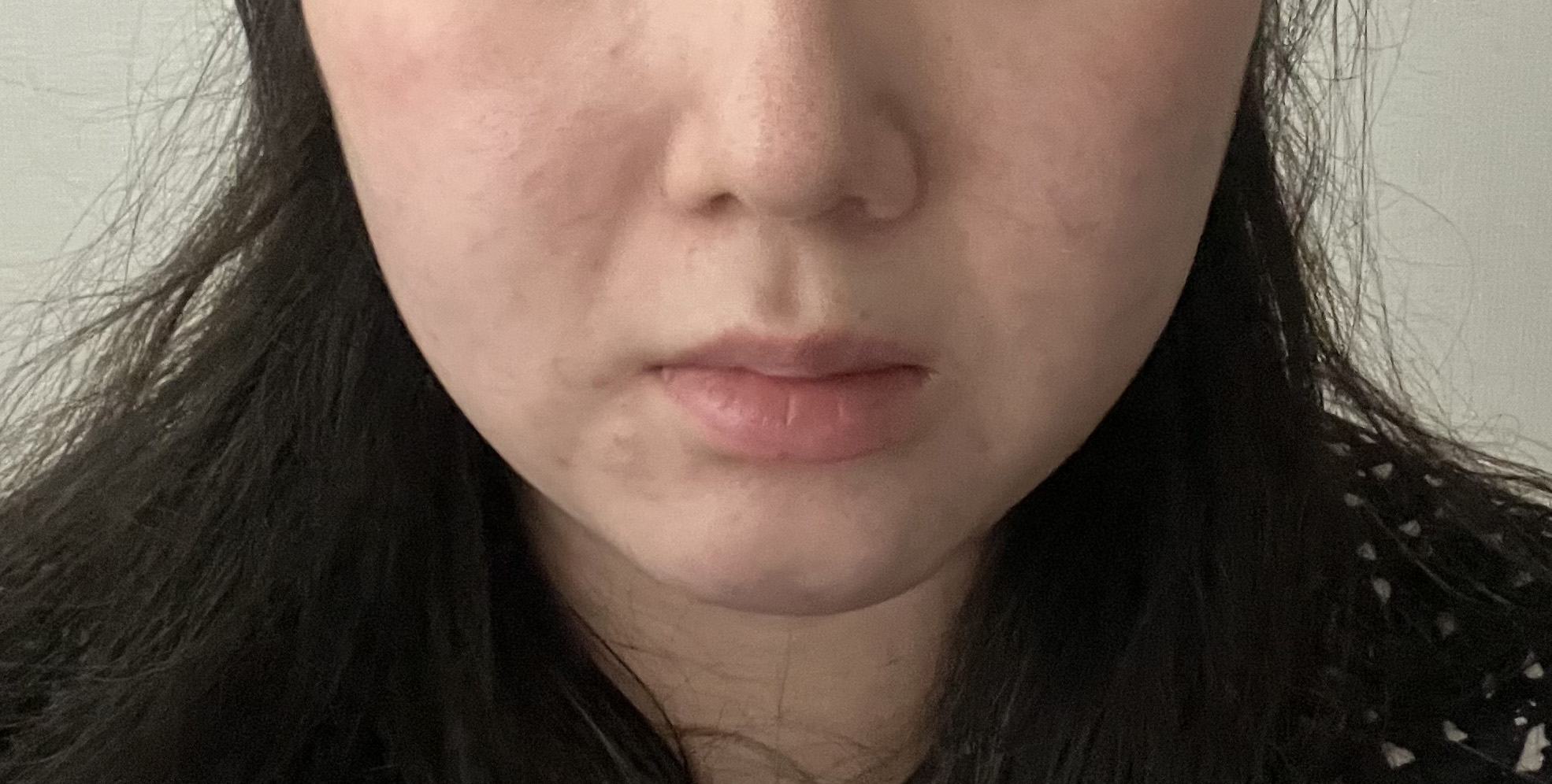 얼굴지방흡입 진짜 후회 안해요ㅠㅠㅠㅠㅠㅠ