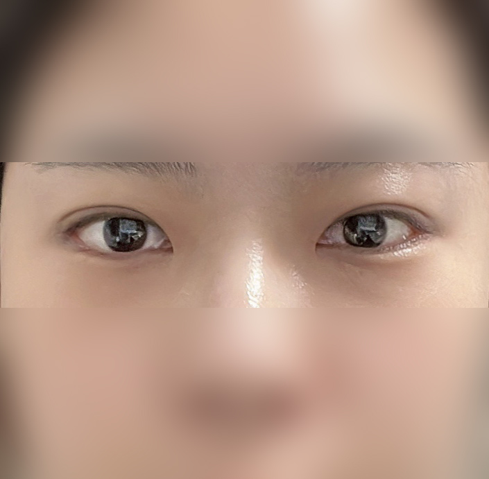 만족해서 쓰는 눈매교정후깅