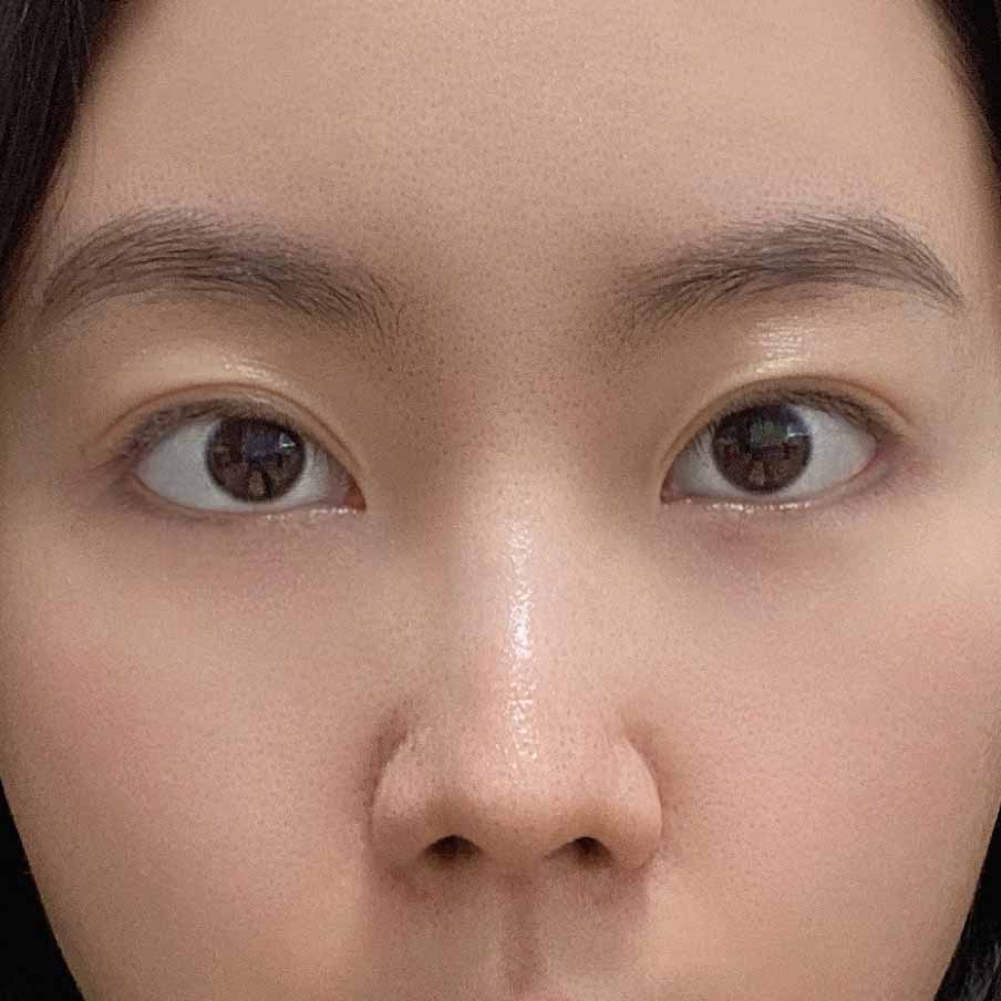 망고트임재수술 + 콧볼축소재수술 했어요