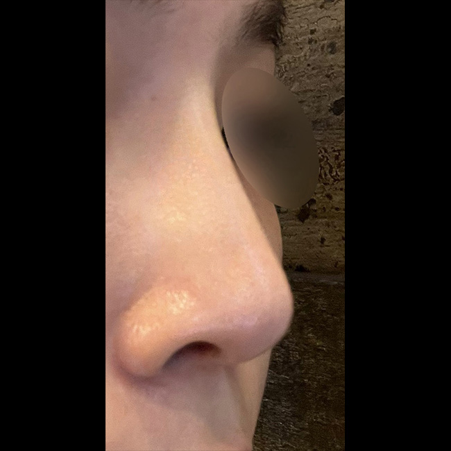 무보형물코수술 만족합니다!! 추천추천