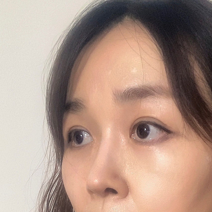 쌍꺼풀 재수술, 하안검, 코재수술, 내시경이마거상 후기~