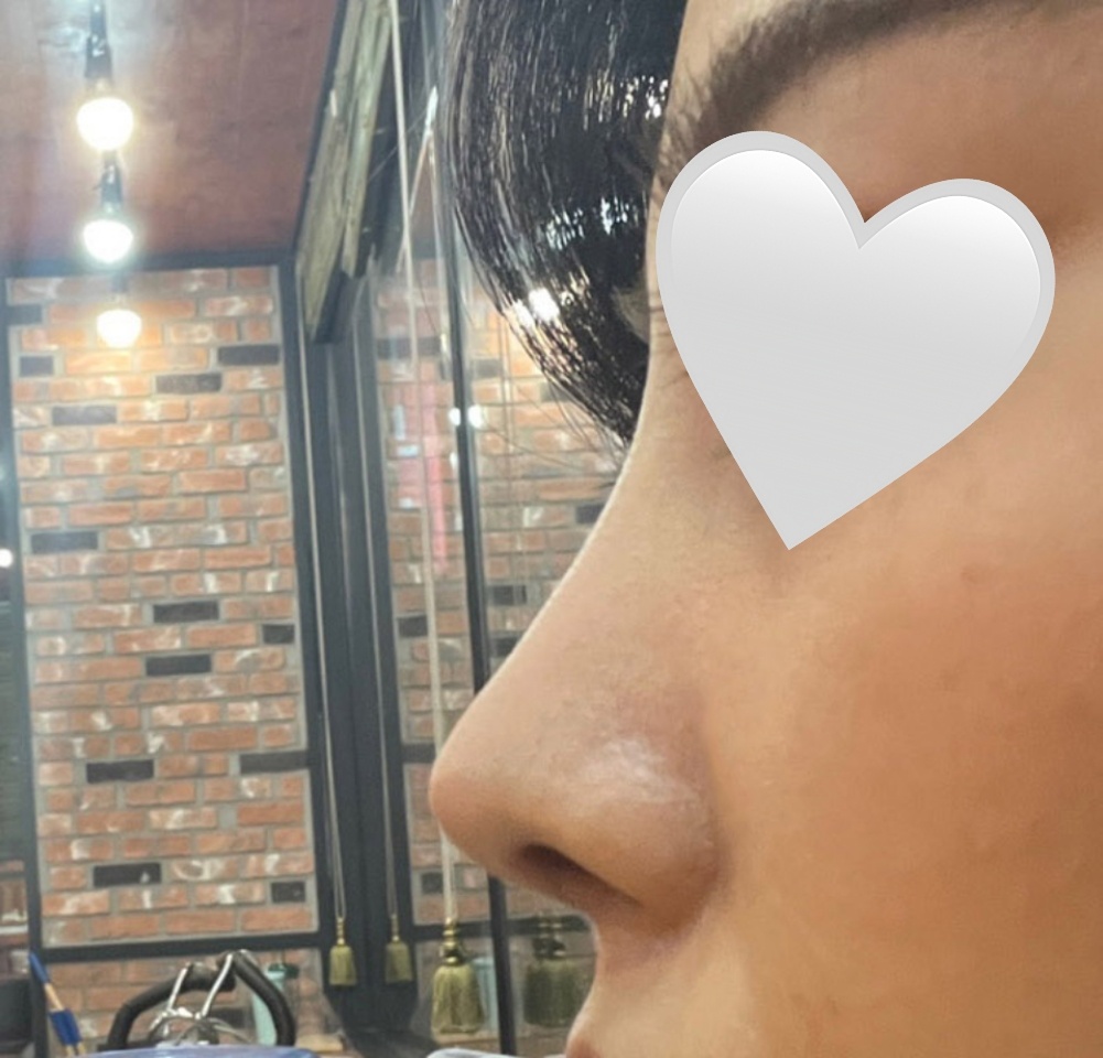 짧은코+복코수술!!예뻐졌어요